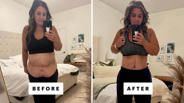 I Got Skin Removal Surgery After Losing 230 Pounds On a GLP-1